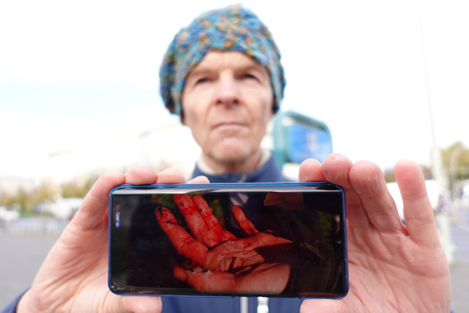 Klima-Aktivist Michael Winter zeigt ein Foto seiner verletzten Hand.
